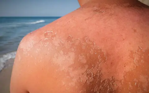 Peau qui pèle après un coup de soleil. La guérison peut prendre plusieurs jours, voire semaines.