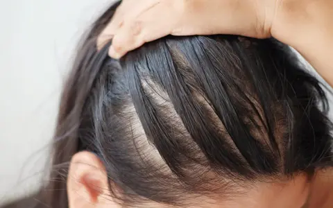 Nahaufnahme der Kopfhaut einer Person, die sich kratzt. Möglicherweise ein Anzeichen von Neurodermitis Kopfhaut.
