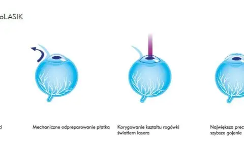 Korekcja krótkowzroczności: Od okularów po laser wybierz mądrze!