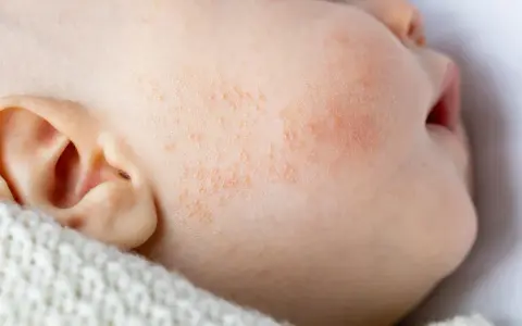 Gros plan sur la joue d'un bébé présentant des rougeurs et des petites plaques, signes d'eczéma bébé. La peau est irritée.