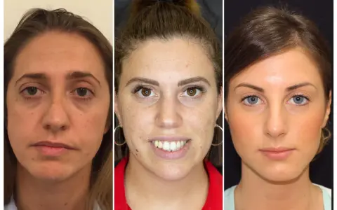 Confronto prima/dopo: zigomi rifatti male, con risultati innaturali e gonfi.