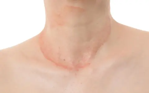 Piel con erupción rojiza y escamosa en el cuello, sugiriendo la presencia de hongos en el cuello.