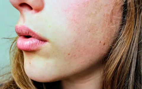Primo piano del viso di una giovane donna con lentiggini e pelle che si squama, evidenziando una texture ruvida e secca.