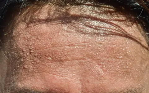 Frente sudorosa con gotas de agua. ¿Buscas trucos para no sudar por la cabeza?