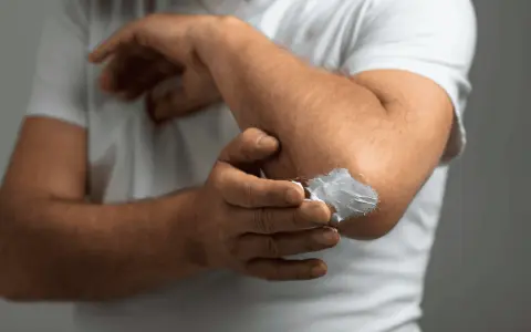 Mężczyzna smaruje łokieć kremem. Szukasz najlepszej kliniki leczenia łuszczycy?