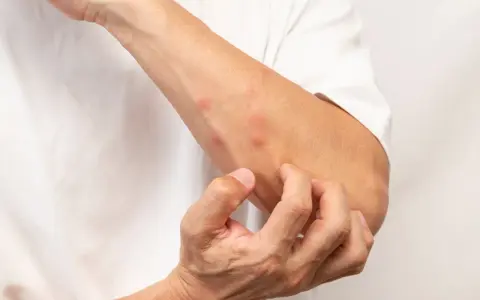 Braccia con punture rosse e gonfie, la persona si gratta perché mi sento pungere dappertutto e prurito.