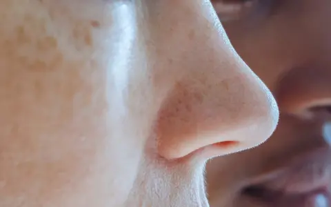 Gros plan sur un nez humain, montrant des pores dilatés et des filaments sébacés. Des taches de rousseur parsèment la peau.