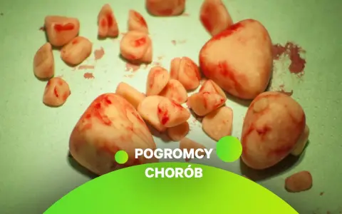 Kamienie w cewce moczowej, które mogą być usuwane domowymi sposobami.