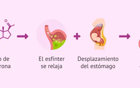Aumento de progesterona y desplazamiento del estómago en el embarazo causan ardores estomacales.