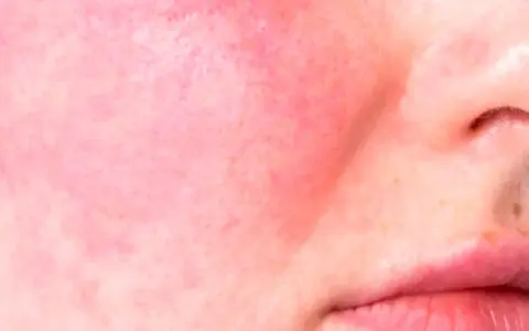 Primo piano di pelle con rosacea, arrossamento diffuso e piccoli vasi sanguigni visibili sulle guance e sul naso.