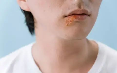 Zbliżenie na usta z opryszczką. Szukasz sposobu na opryszczkę w 1 dzień?