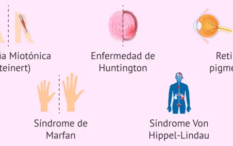 Ilustraciones de distrofia miotónica, Huntington, Marfan, Von Hippel-Lindau y retinosis pigmentaria, ejemplos de herencia autosomica dominante.