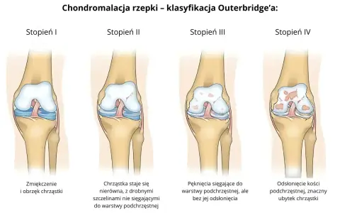 Ilustracja pokazuje cztery stopnie chondromalacji rzepki wg Outerbridge'a: od zmiękczenia chrząstki do odsłonięcia kości.