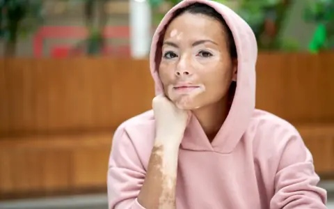 Jeune femme au visage et bras marqués par la dépigmentation de la peau, portant un sweat à capuche rose.
