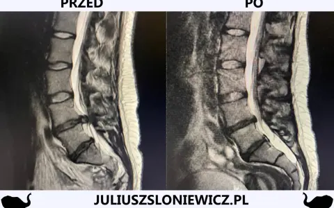 Rwa kulszowa: Zrozum objawy, znajdź ulgę i pokonaj ból!
