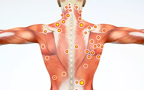 Muskulatur med markerade trapezius triggerpunkter. Röda cirklar med gula prickar visar var smärtan kan sitta.