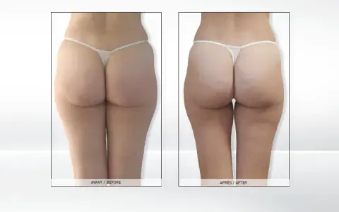 Endermologia: Ile cm stracisz? Realne efekty i wskazówki