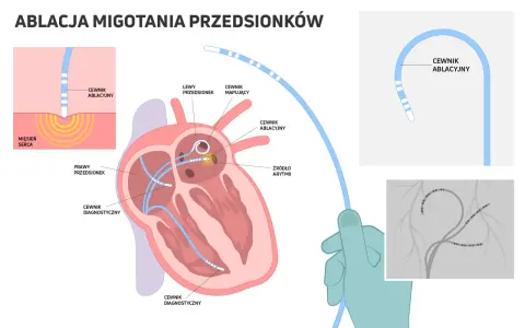 Ilustracja wyjaśnia, co to ablacja migotania przedsionków. Pokazuje cewniki diagnostyczne i ablacyjne w sercu, lokalizujące źródło arytmii.