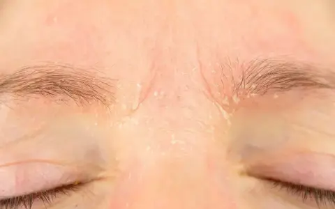 Skóra nad oczami jest zaczerwieniona i łuszczy się, co może być jednym z retinol skutki uboczne.