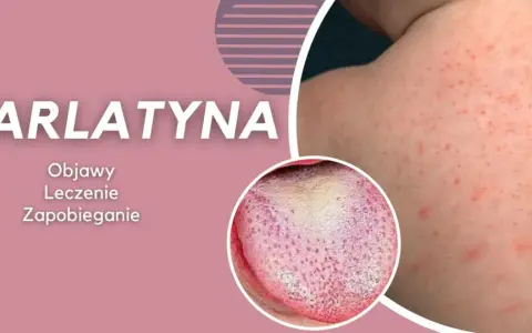 Szkarlatyna: czerwona wysypka na skórze i malinowy język. Objawy, leczenie i zapobieganie. Podobne do rumienia zakaźnego, ale wymaga innej diagnostyki.