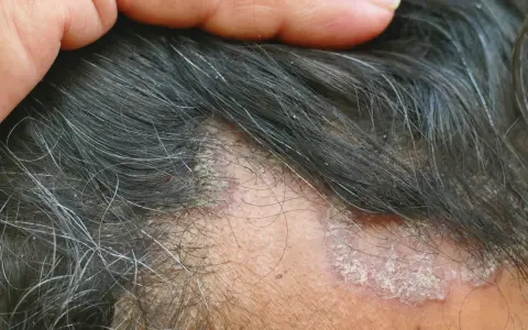 Juckende Kopfhaut mit schuppigen Stellen und Haarausfall. Eine Hand berührt die betroffenen Stellen.
