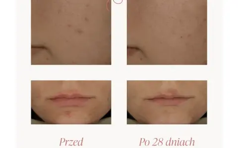 Przed i po 28 dniach stosowania Twojej Kaya kuracji złuszczającej: widoczna poprawa cery, zmniejszenie porów i niedoskonałości.