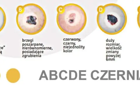 ABCDE czerniaka: asymetria, brzegi, czerwony/czarny kolor, duży rozmiar, ewolucja. Obrazki pokazują, jak wygląda czerniak.