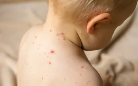 Skóra dziecka pokryta czerwonymi kropkami, objawami choroby, takiej jak odra.