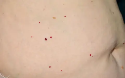 Czerwone pieprzyki na brzuchu, drobne i kilka większych, rozrzucone na jasnej skórze.