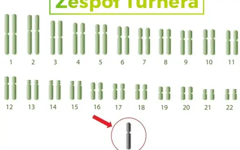Kariotyp przedstawiający zespół Turnera, z zaznaczonym brakiem jednego chromosomu X (XO).