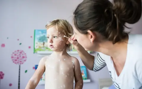 Madre aplica crema a su bebé con miliaria. El niño rubio tiene la piel cubierta de pequeñas erupciones blancas.