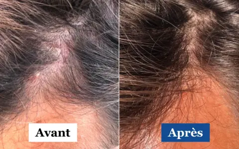 Comparaison avant/après d'un cuir chevelu atteint de psoriasis et dermite séborrhéique. La partie gauche montre des plaques rouges et squameuses, la droite une peau apaisée.