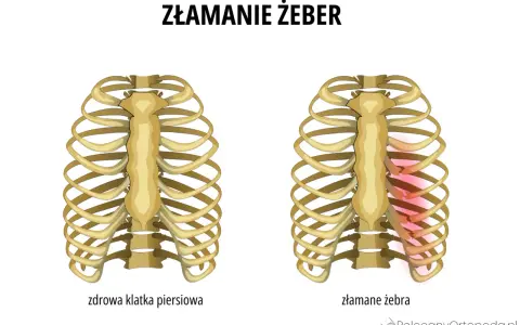 Dwie klatki piersiowe: zdrowa i z widocznymi złamaniami żeber zaznaczonymi na czerwono.