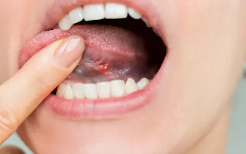 Otwarta usta z widocznym zapaleniem języka. Palec wskazujący dotyka czerwonej, opuchniętej zmiany na języku.