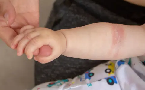 Babyarm mit geröteter Stelle, die auf einen Hautpilz am Po hindeuten könnte.