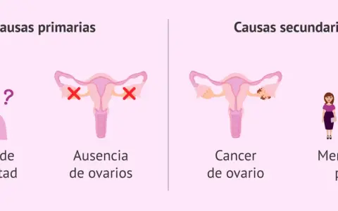Ilustración explica que se puede tener la regla sin sangrar, mostrando causas primarias (retraso pubertad, ausencia ovarios) y secundarias (cáncer ovario, menopausia precoz).