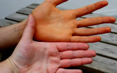 Zwei Hände im Vergleich: Eine ist orange gefärbt, was auf die carotin wirkung hindeutet. Die andere Hand hat eine normale Hautfarbe.