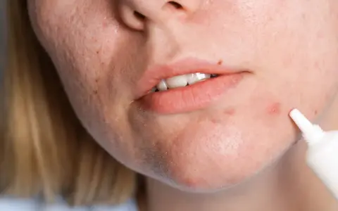 Kobieta aplikuje krem na wyprysk, szukając skutecznych zabiegów na trądzik hormonalny.