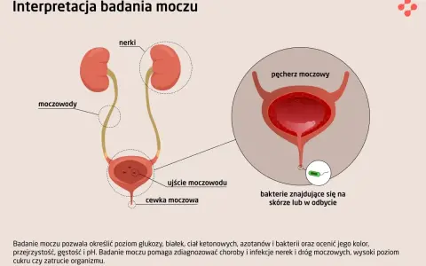 Ilustracja układu moczowego z zaznaczonymi nerkami, moczowodami i pęcherzem. Widoczne bakterie pałeczki w moczu, mogące świadczyć o infekcji.