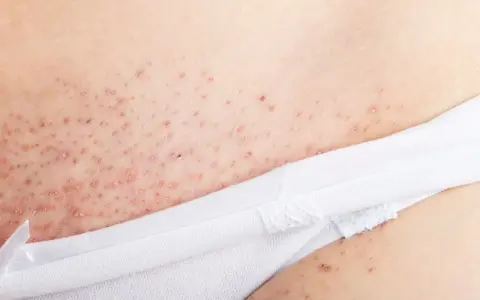Närbild på irriterad hud efter rakning, med små röda prickar och knottror.
