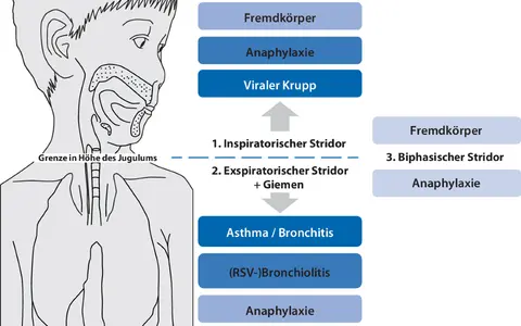 Schema zeigt Ursachen für Atemnot: Epiglottitis, Fremdkörper, Anaphylaxie, Krupp. Warum kriege ich schlecht Luft? Hier sind mögliche Gründe.