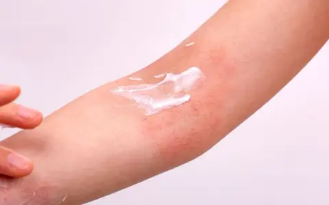 Application de crème sur une plaque sèche et rouge sur le bras, soulageant l'irritation cutanée.