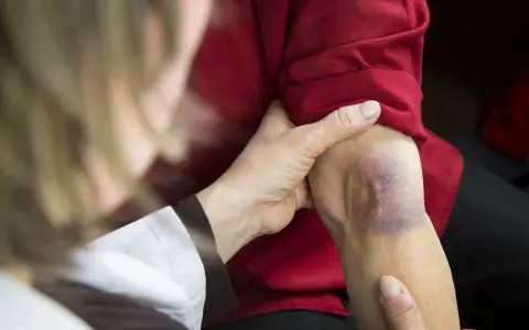 Dłoń bada siniak na ramieniu, który może wskazywać na problemy z krzepliwością krwi.