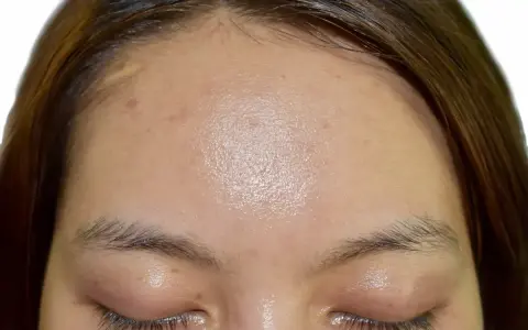 Czoło z widocznym błyszczeniem, oznaki nadmiernego sebum, kilka drobnych niedoskonałości i piegów.