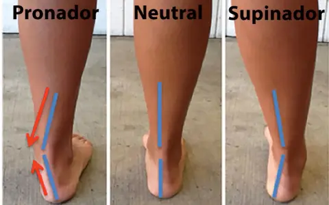 Comparación de pisada: pronador, neutral y supinador. La pisada supinadora muestra el tobillo inclinado hacia afuera.