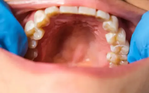 Widoczne zęby i jama ustna, z niebieską rękawiczką dentystyczną. Na dziąśle widoczny jest krwiak.