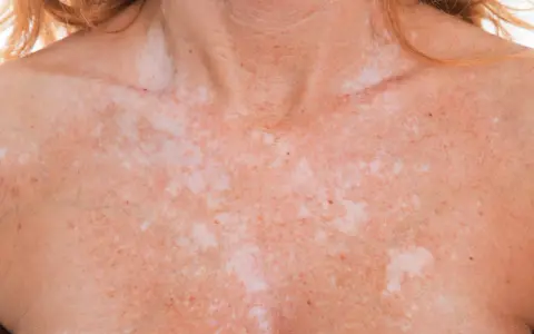 Poitrine et cou d'une personne présentant une dépigmentation de la peau, avec des taches claires et foncées.