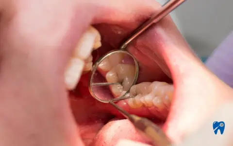 Dentysta bada zęby, widoczne są oznaki chorób zębów, takie jak ubytek.