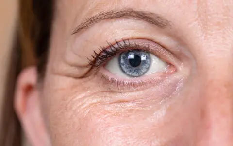 Nahaufnahme eines Auges mit knittriger Haut unter den Augen. Hausmittel können helfen, die Haut zu straffen.