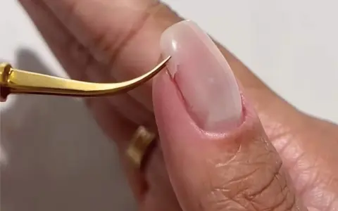 Pince dorée retirant délicatement un ongle arraché, révélant la peau sensible.